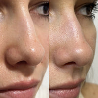 CLEAR PORE DUO