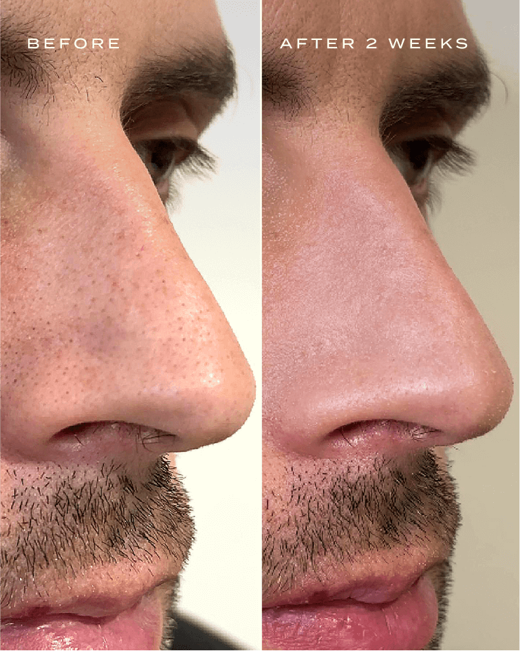 CLEAR PORE DUO