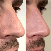 CLEAR PORE DUO