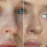 NOSE PATCHES