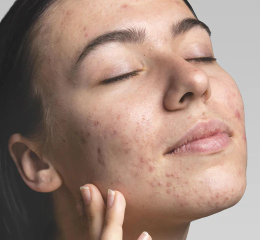 Hormonal Acne: Causes, Treatments, and Prevention