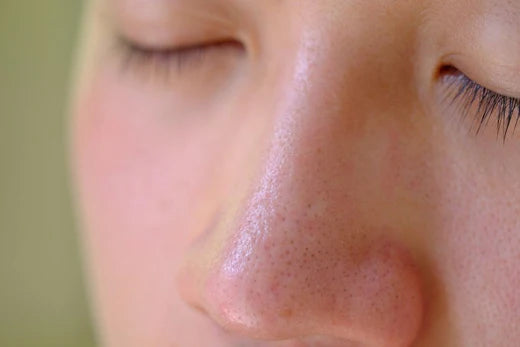 Skin Troubles? It Might Be Sebaceous Filaments, Not Blackheads