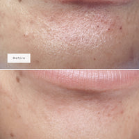 CHIN PATCHES