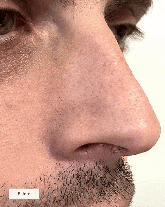 LUMI : Parche para Nariz Nocturno – LumiCare