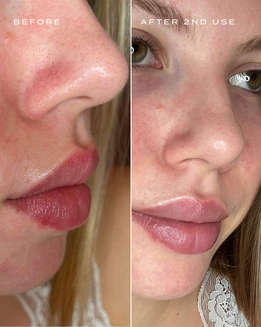 Pores before and after a nose patch 