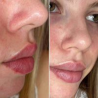 Pores before and after a nose patch 